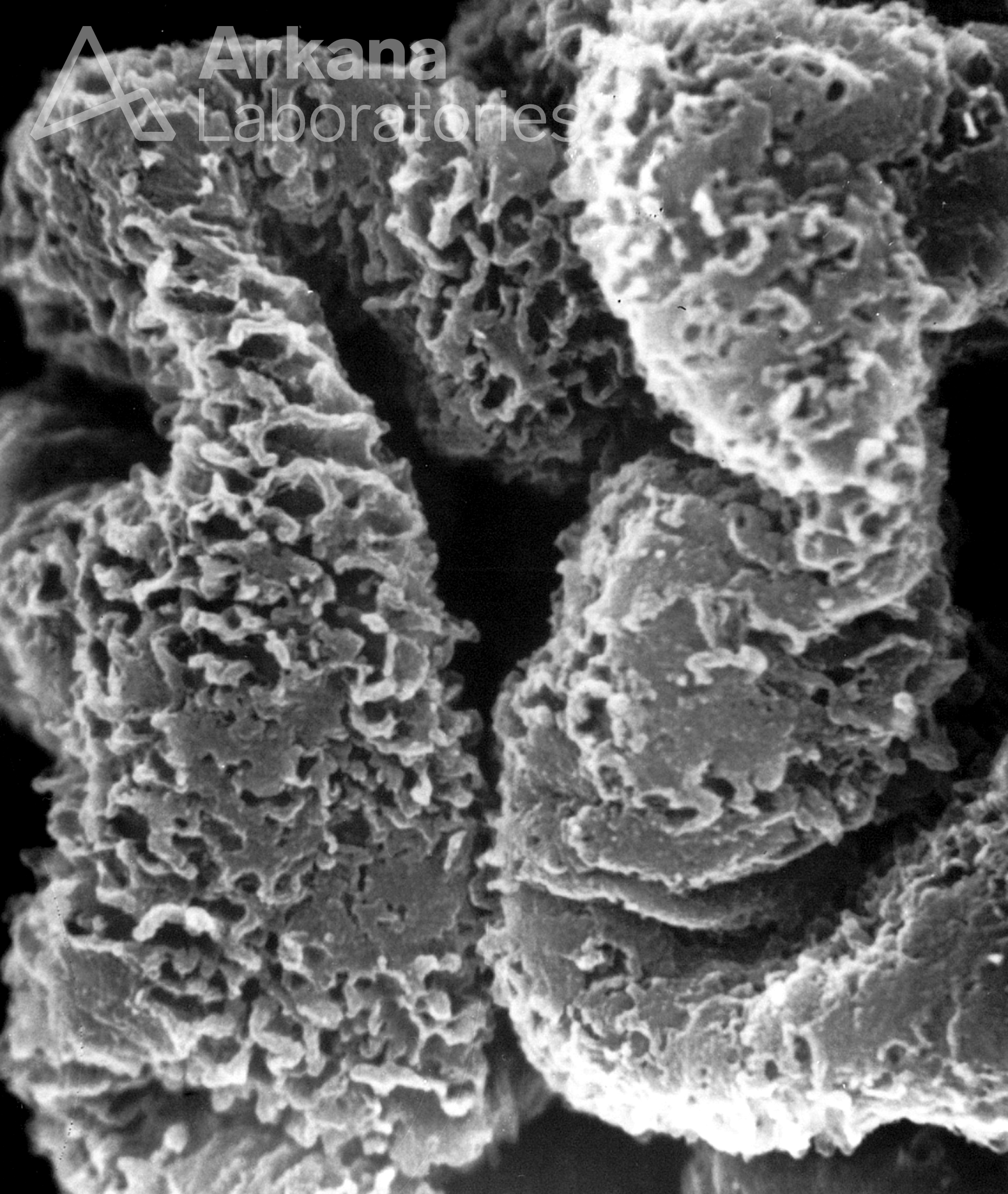 membranous glomerulonephritis, stage III