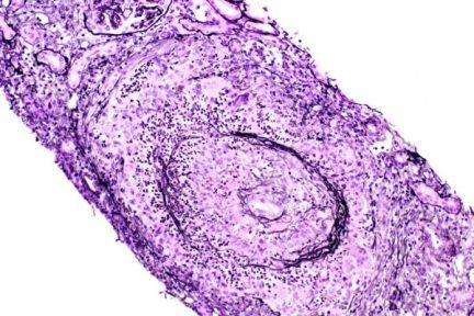 ANCA-associated vasculitis