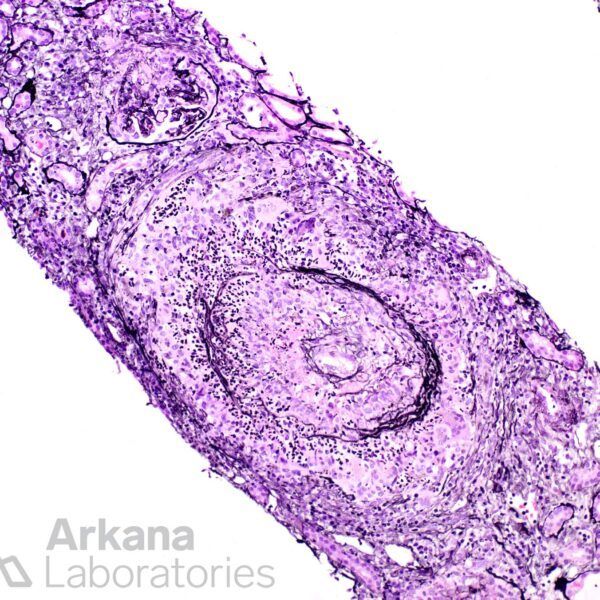 ANCA-associated vasculitis