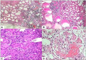 kidney pathology, lupus nephritis, lupus disease week, arkana laboratories