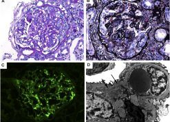 The histopathologic spectrum of kidney biopsies in patients with inflammatory bowel disease