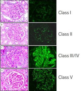 lupus nephritis disease week, arkana laboratories, renal diseases, LN