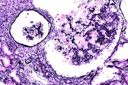 collapsing glomerulopathy