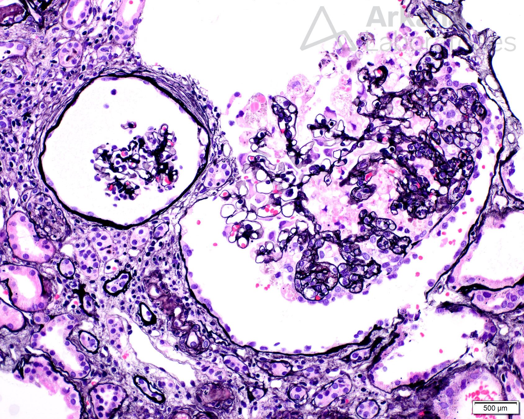 collapsing glomerulopathy