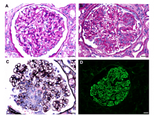 lupus nephritis disease week, arkana laboratories, renal diseases, LN