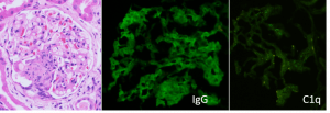 kidney pathology, lupus nephritis, lupus disease week, arkana laboratories