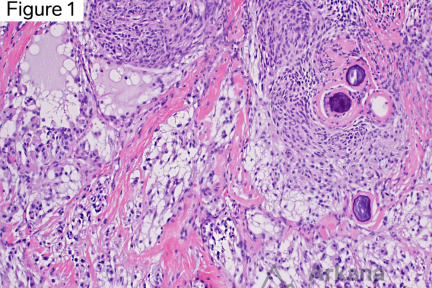 Chordoid meningioma