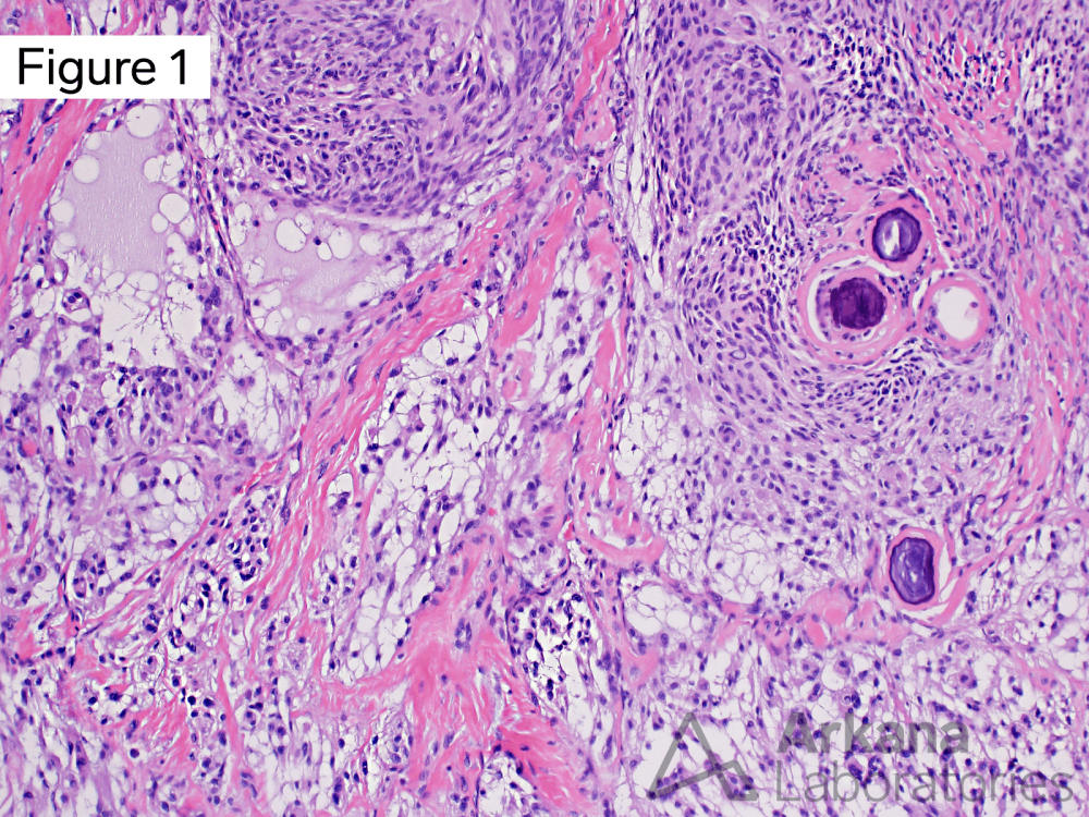 Chordoid meningioma