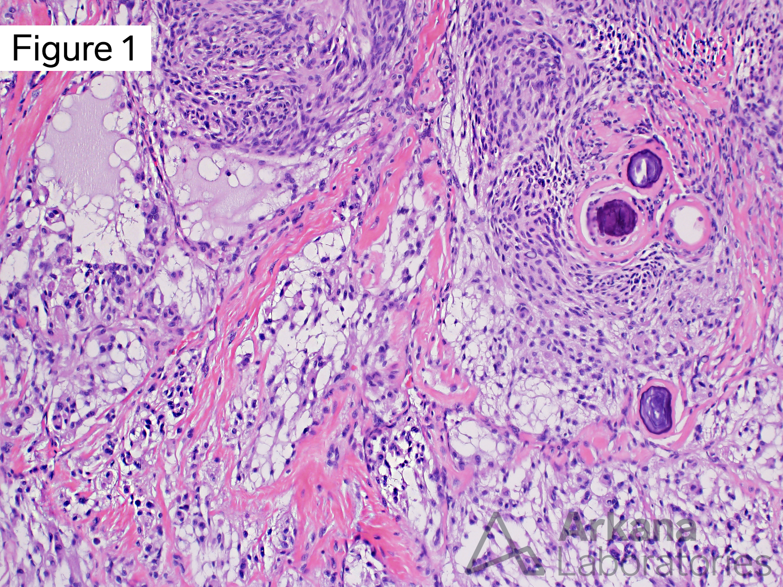 Chordoid meningioma