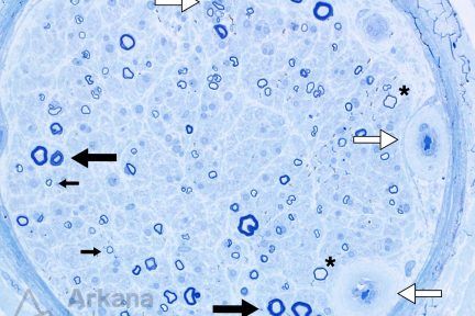 Diabetic, Neuropathy In A Diabetic Patient