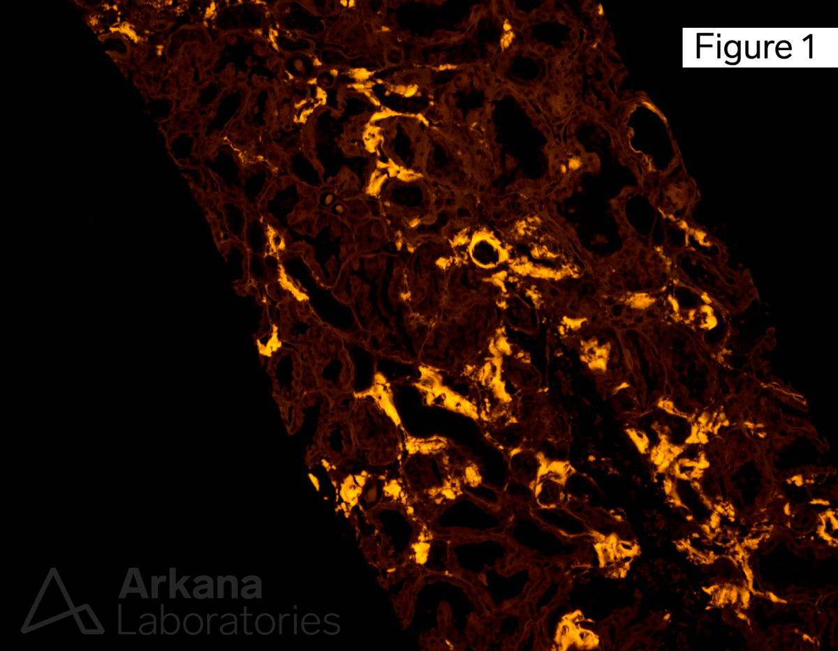 LECT2 amyloidosis