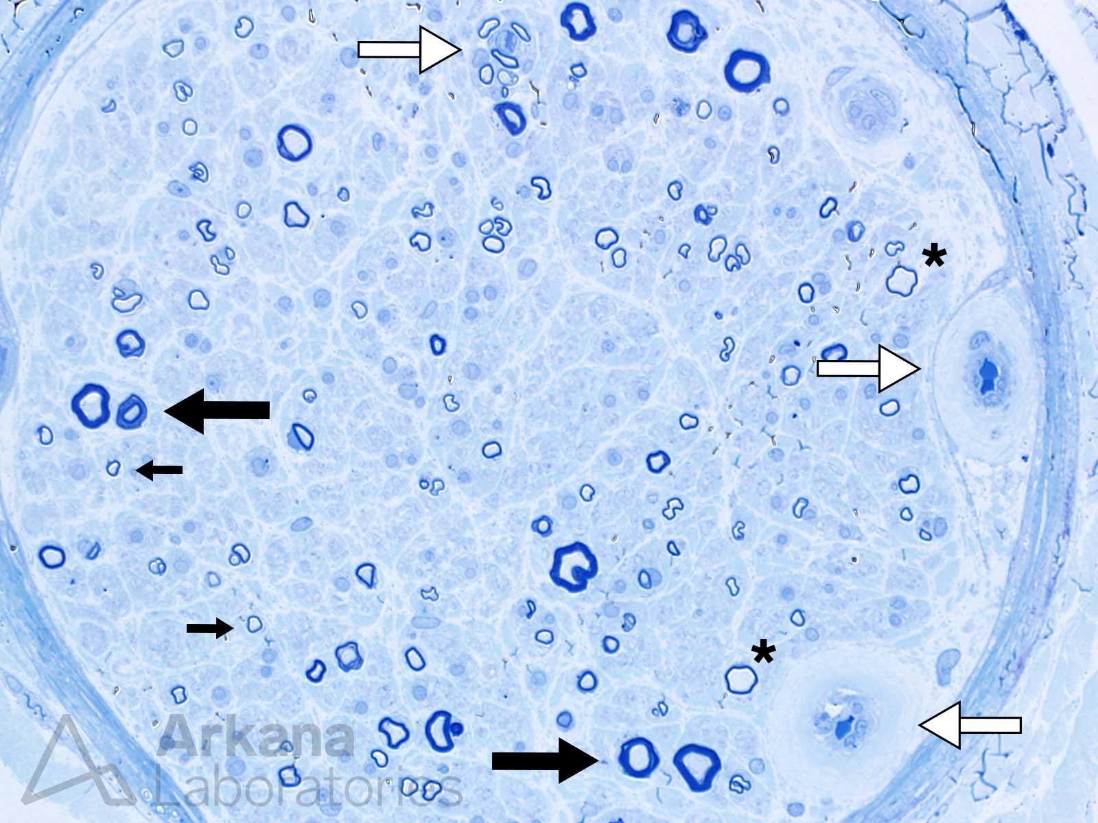 Diabetic, Neuropathy In A Diabetic Patient