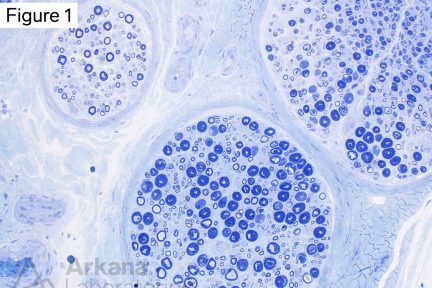 These changes shown on toluidine blue-stained thick section represent partial crush and/or traction artifact