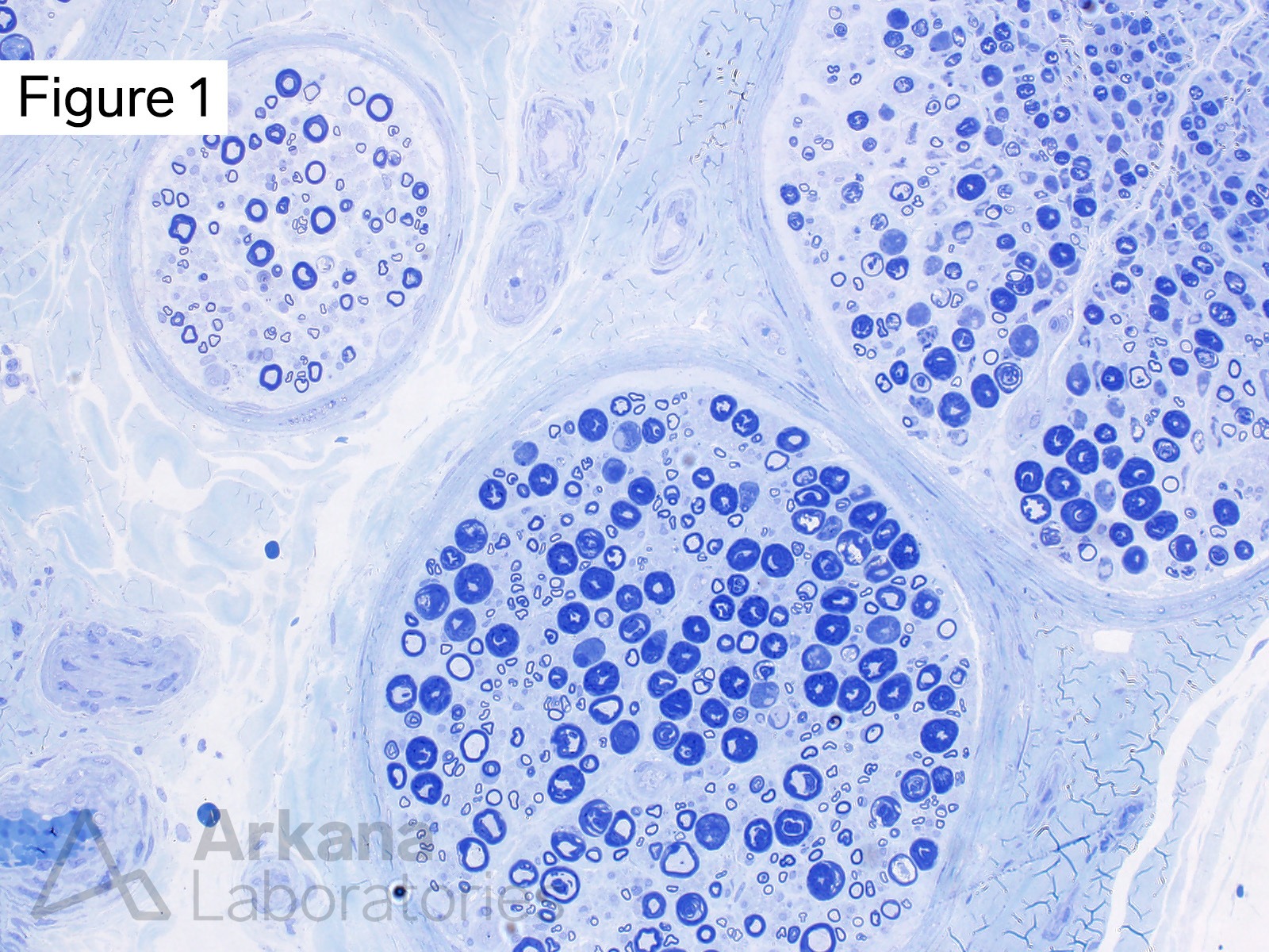 These changes shown on toluidine blue-stained thick section represent partial crush and/or traction artifact