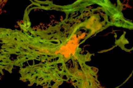 thrombotic microangiopathy