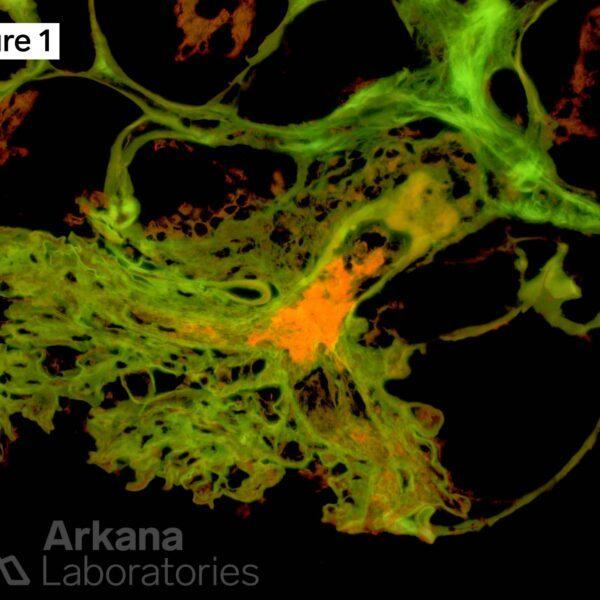 thrombotic microangiopathy