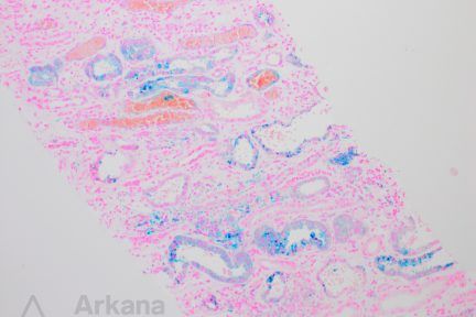 Anticoagulant Nephropathy and Hemosiderosis