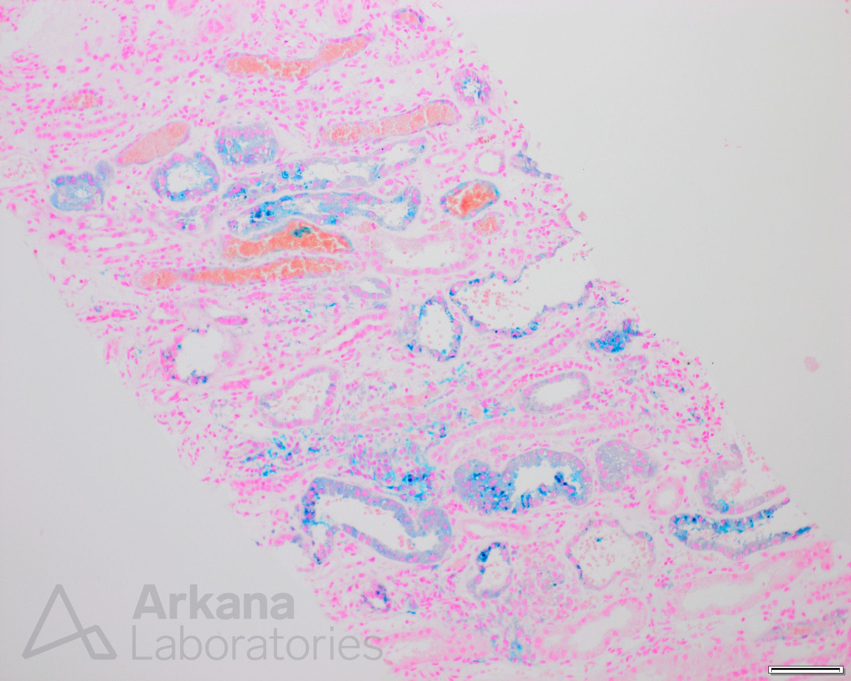 Anticoagulant Nephropathy and Hemosiderosis