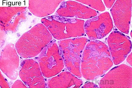 Polyglucosan bodies, Some of the muscle fibers in this image contain multiple refractile angular/rhomboid shaped well-circumscribed structures within the sarcoplasm