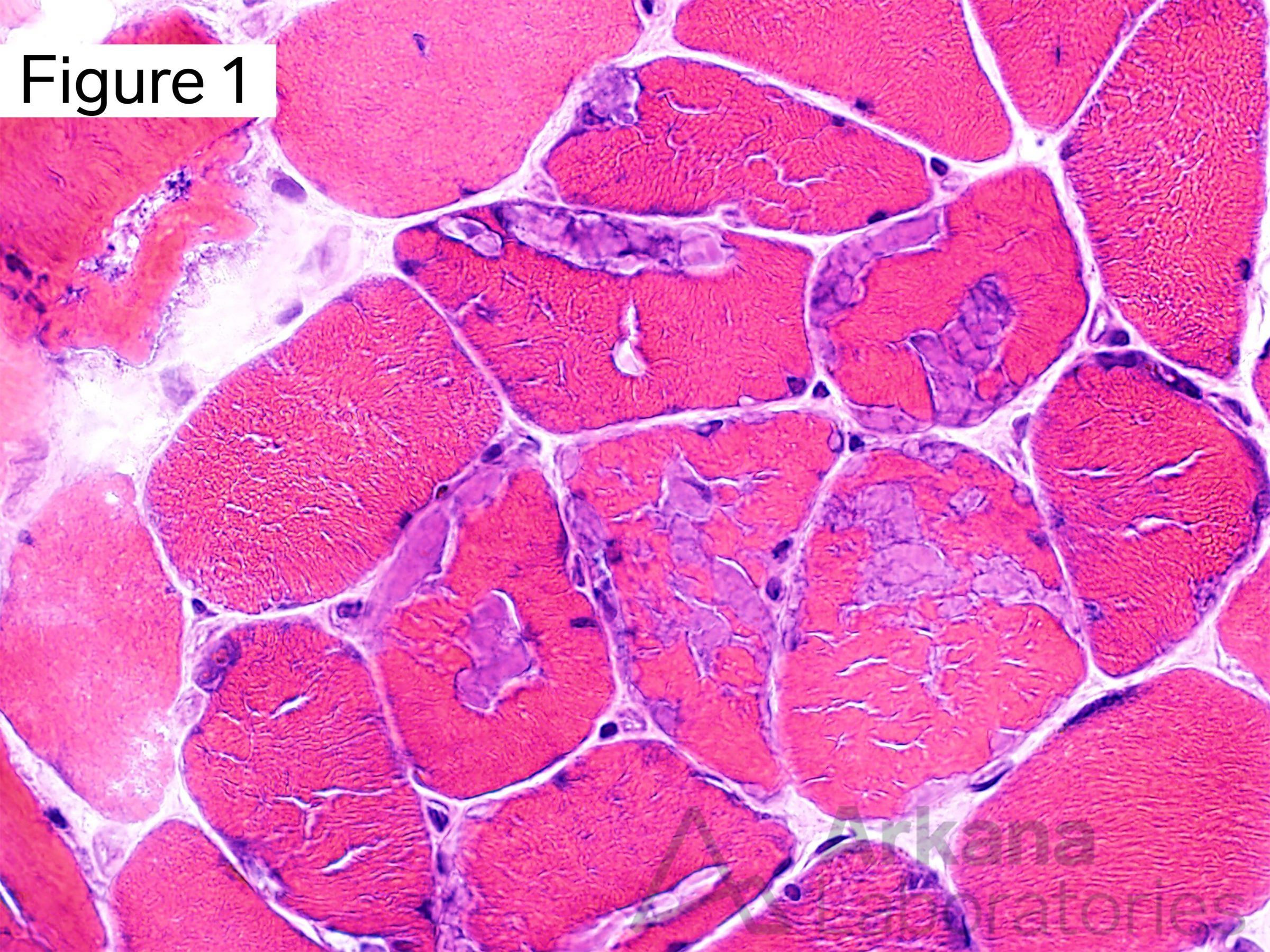 Polyglucosan bodies, Some of the muscle fibers in this image contain multiple refractile angular/rhomboid shaped well-circumscribed structures within the sarcoplasm