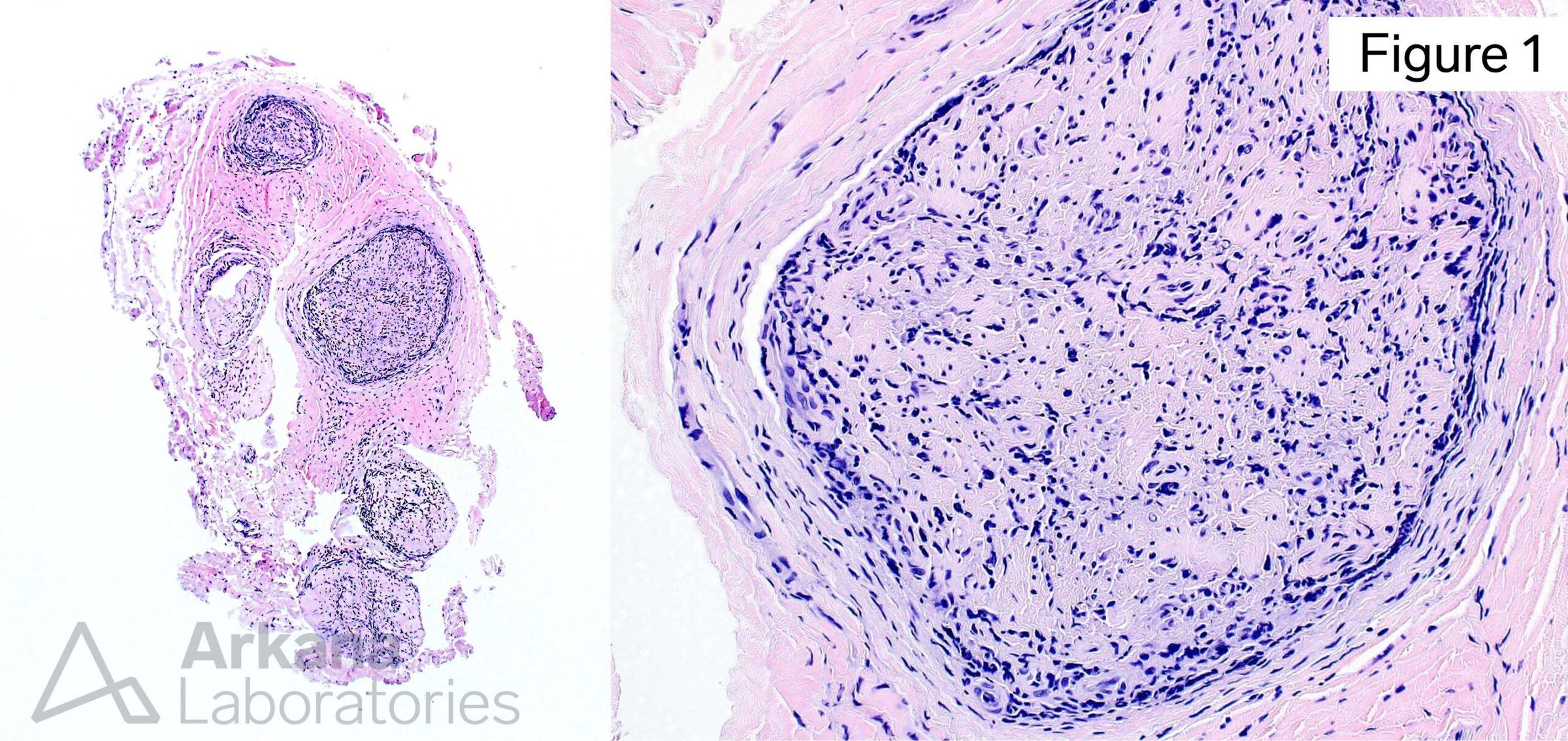 M. leprae PCR, Leprosy