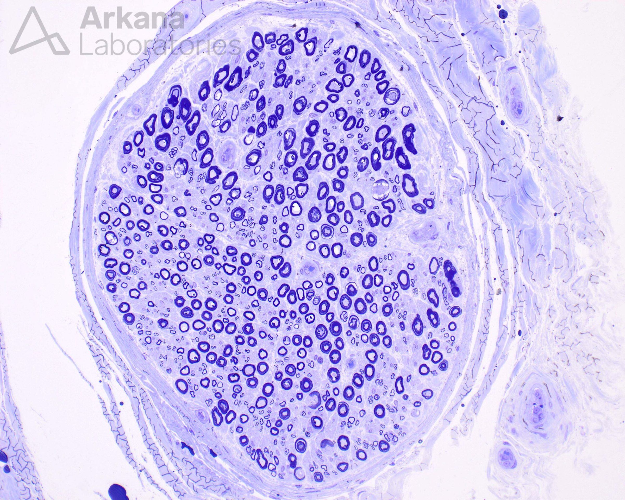 Neuropathy In A Diabetic Patient