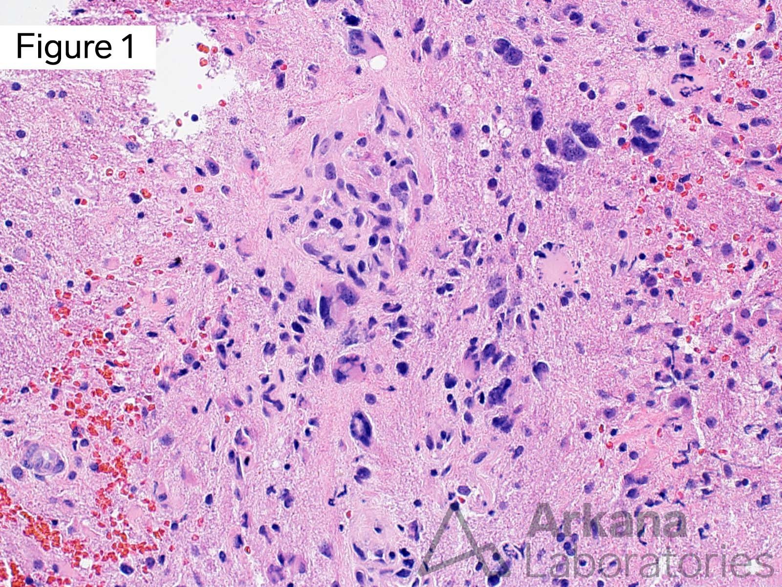 IDH-Wildtype Glioblastoma