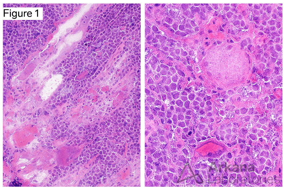 B-cell Lymphoma