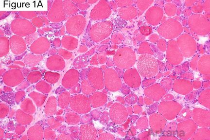 Vacuolar myopathy