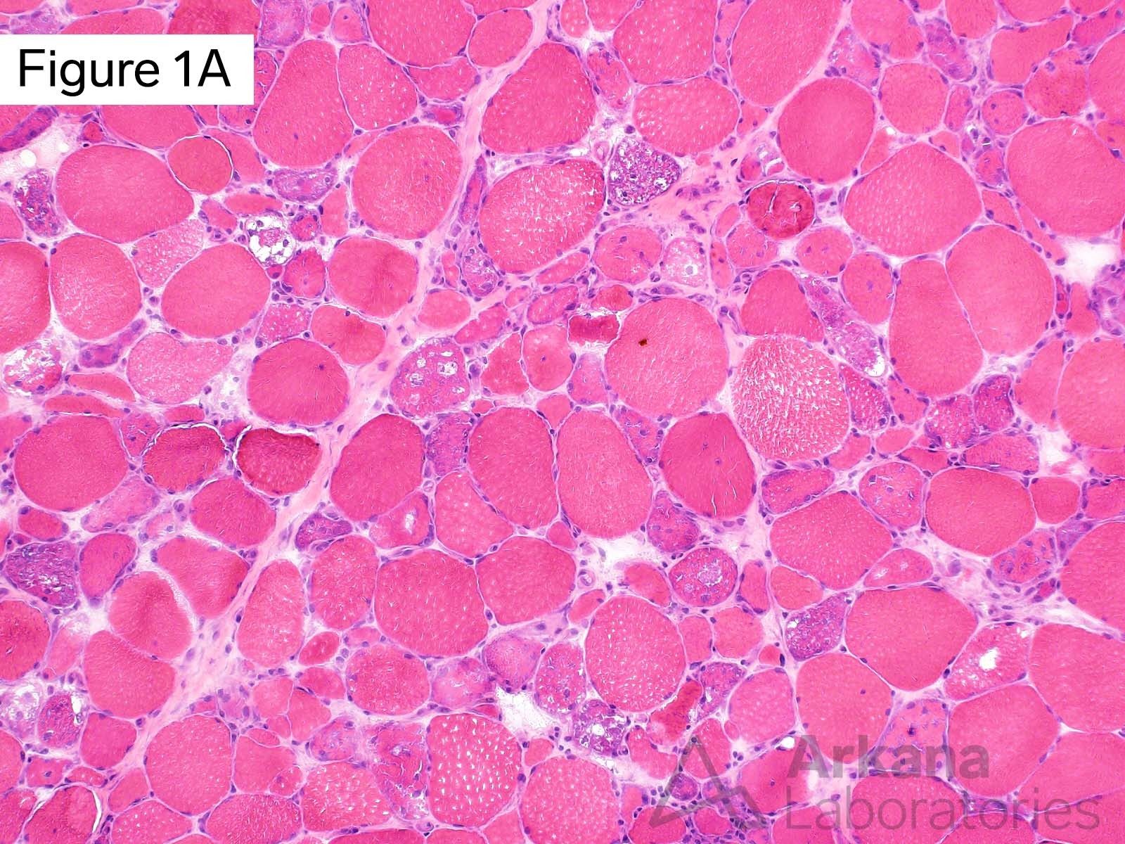 Vacuolar myopathy