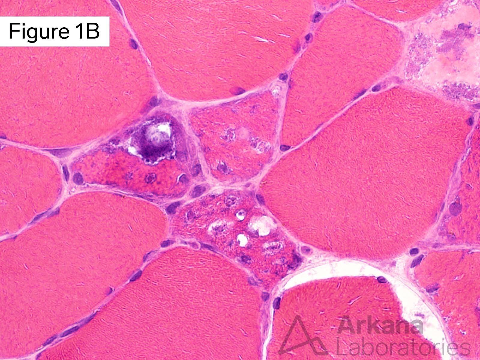 Vacuolar myopathy