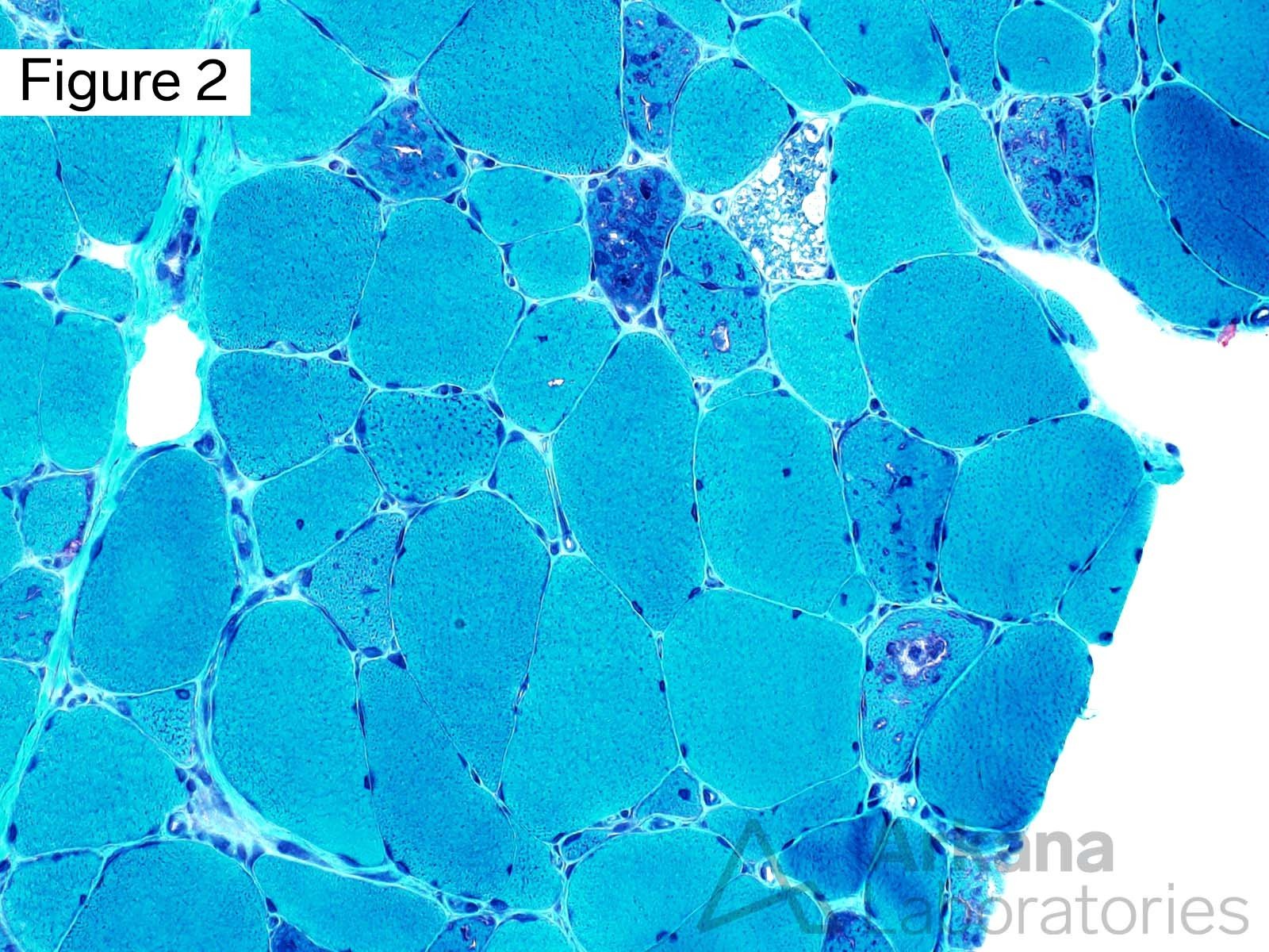 Vacuolar myopathy