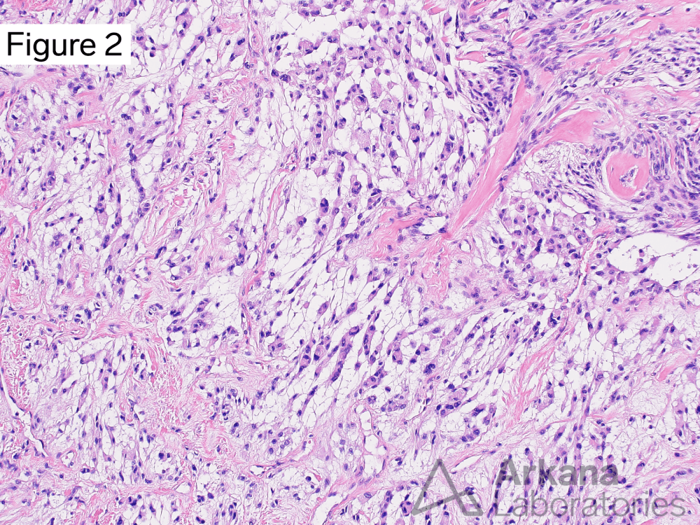 Chordoid meningioma