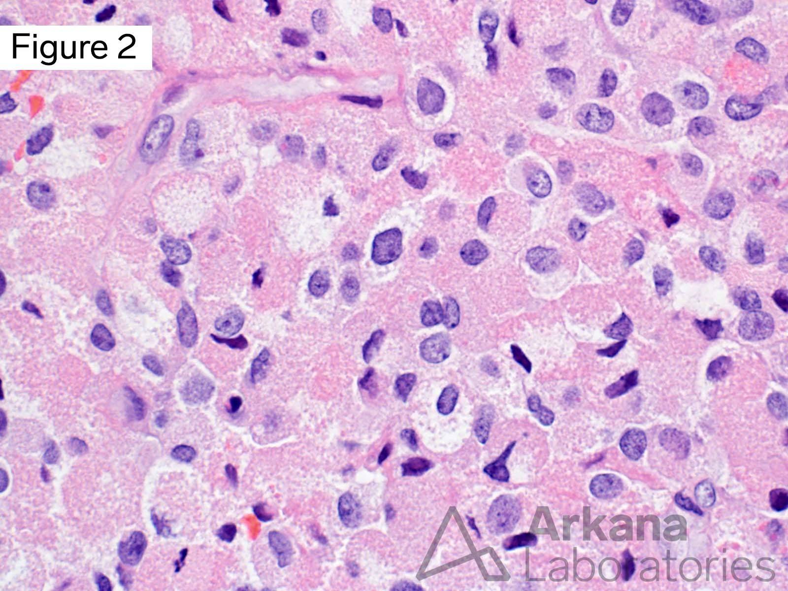 IDH-Wildtype Glioblastoma