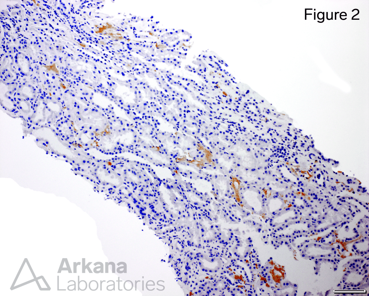 LECT2 amyloidosis