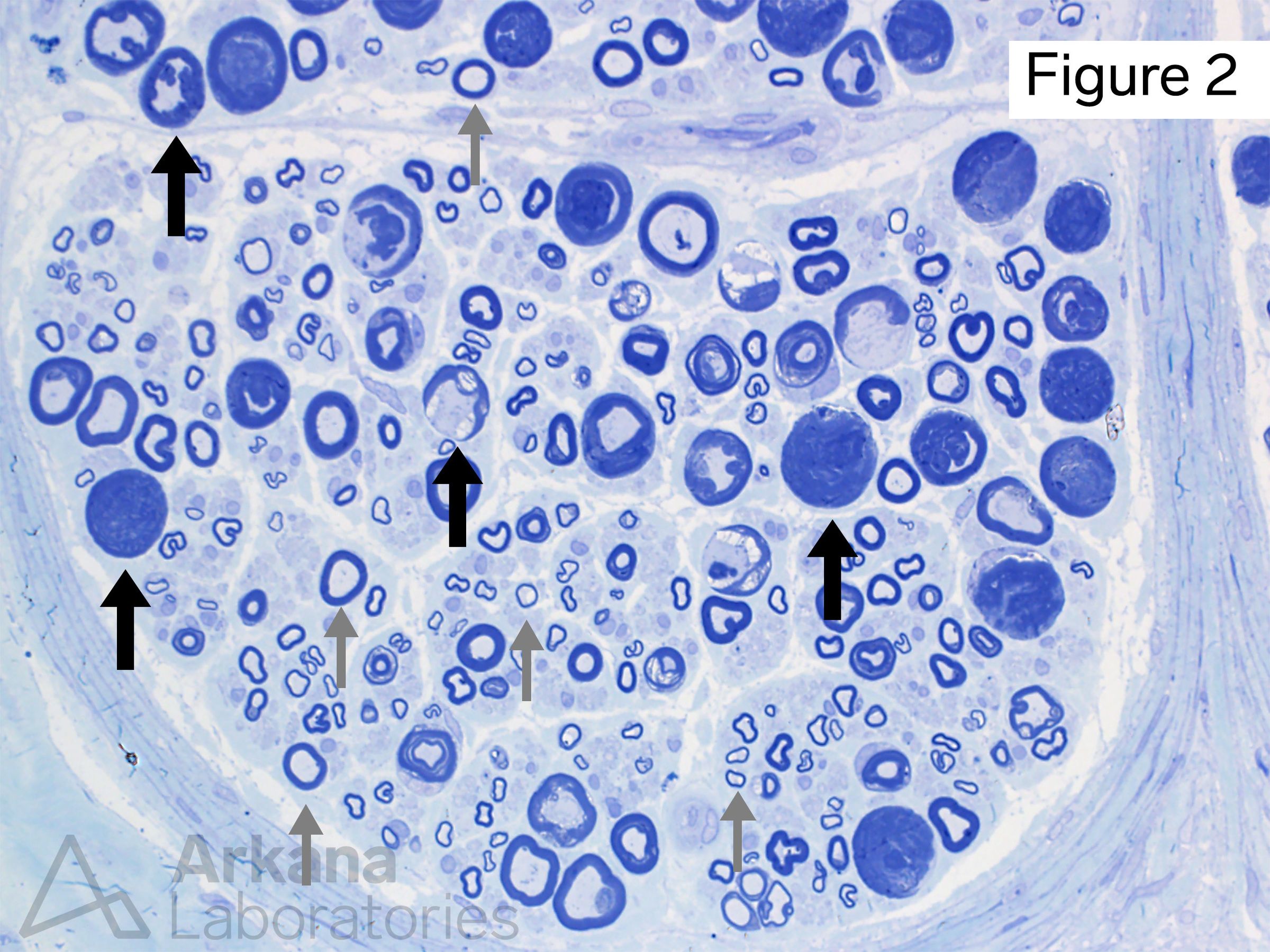 These changes shown on toluidine blue-stained thick section represent partial crush and/or traction artifact