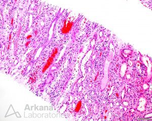 Anticoagulant Nephropathy and Hemosiderosis