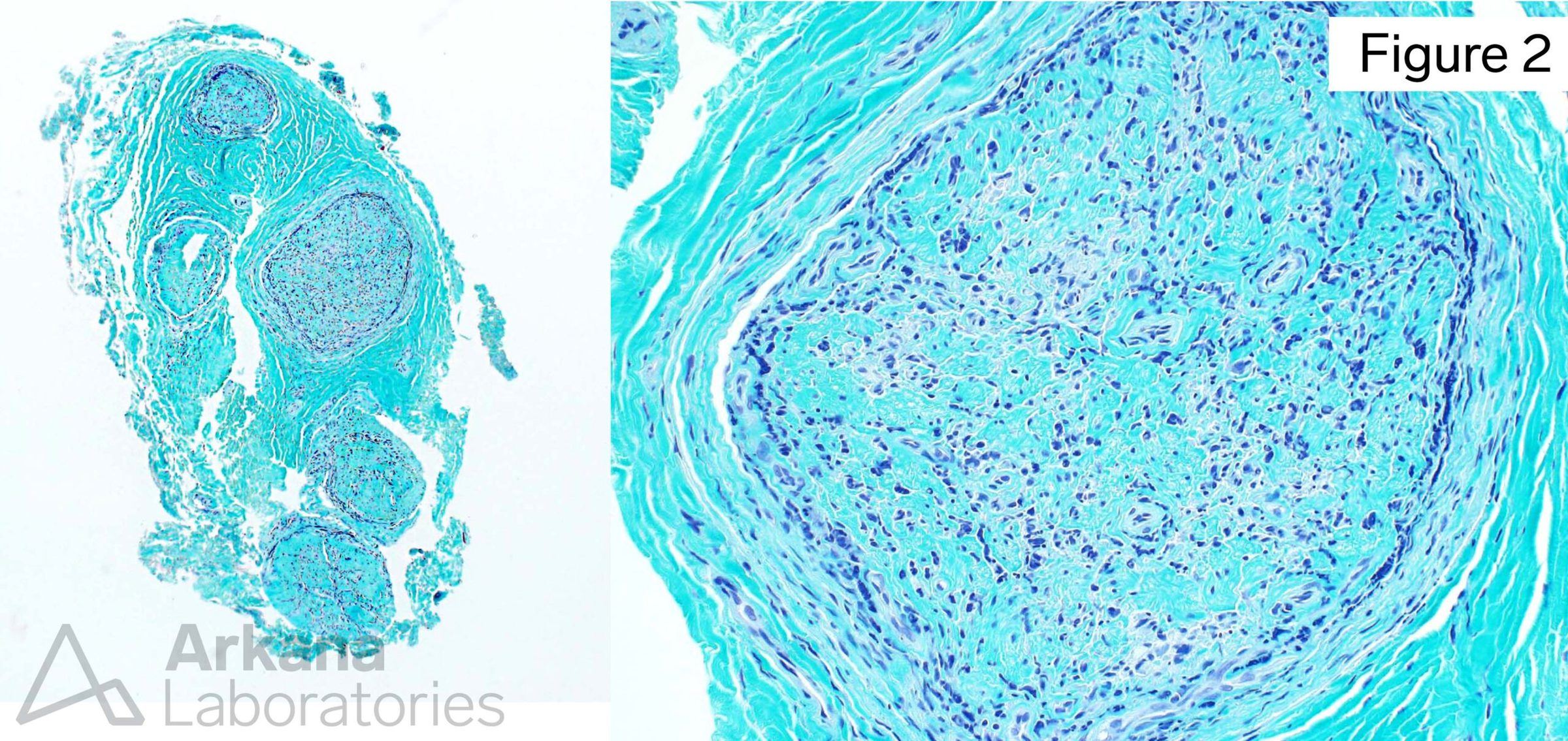 M. leprae PCR, Leprosy