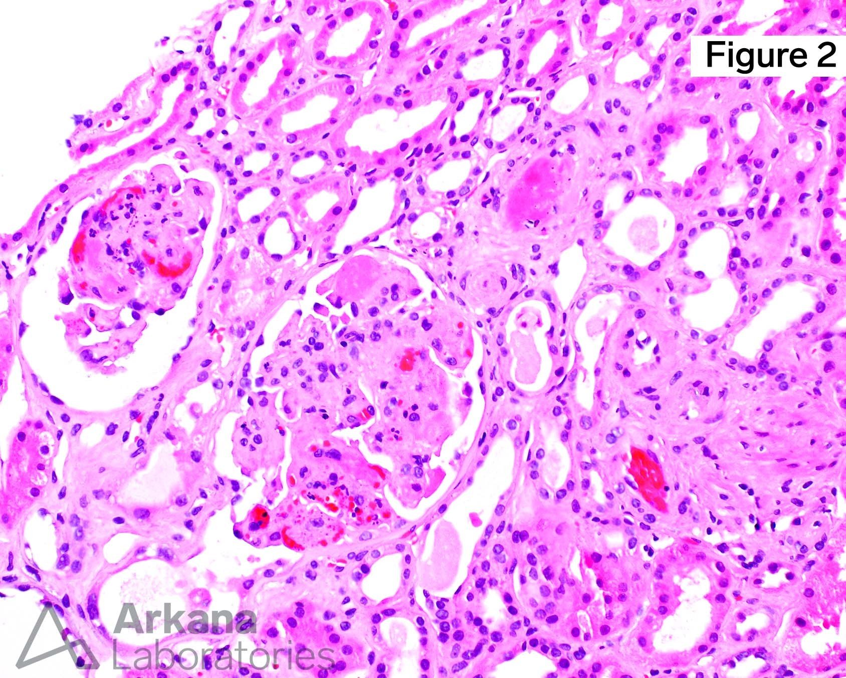 thrombotic microangiopathy