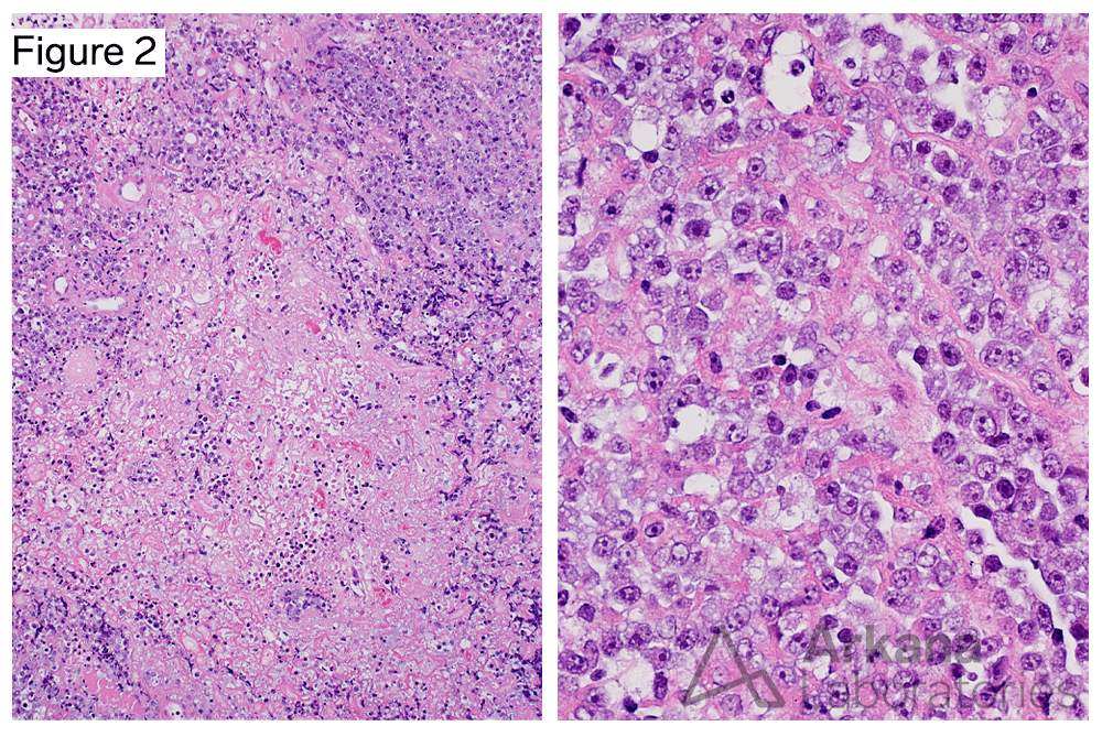 B-cell Lymphoma