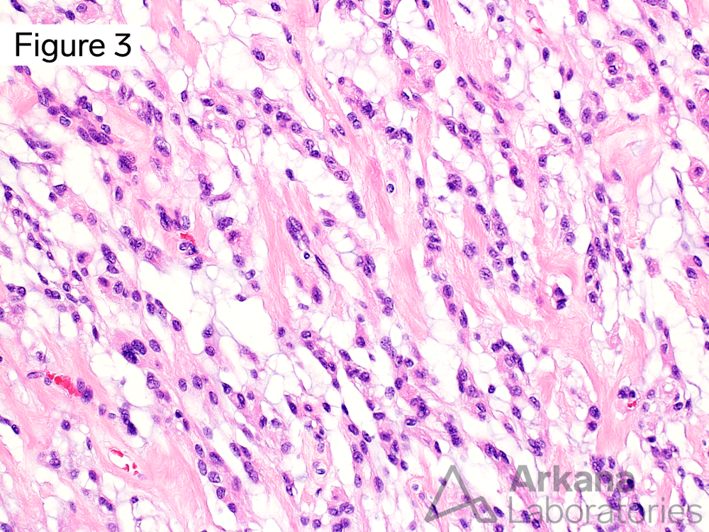 Chordoid meningioma