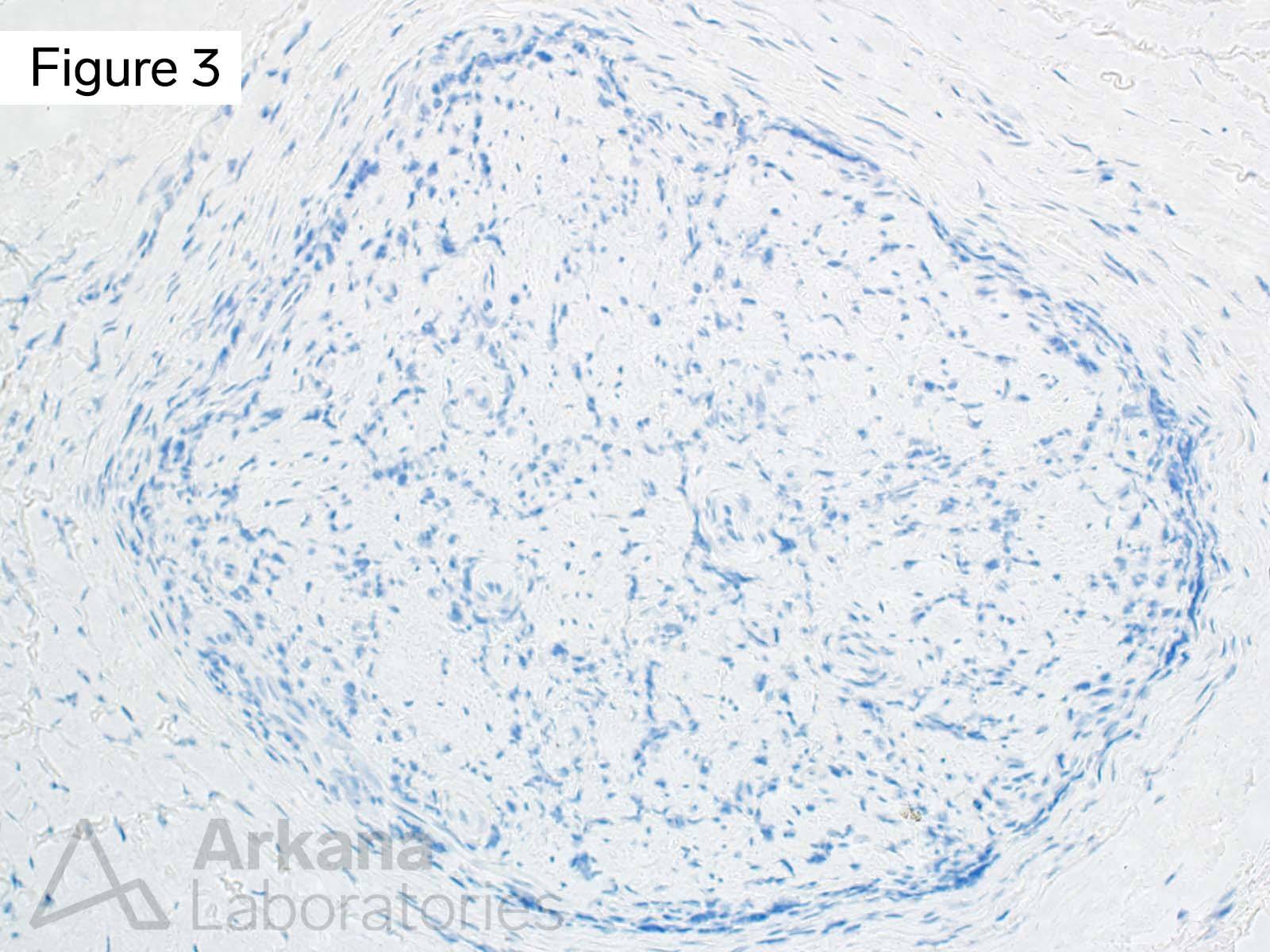 M. leprae PCR, Leprosy