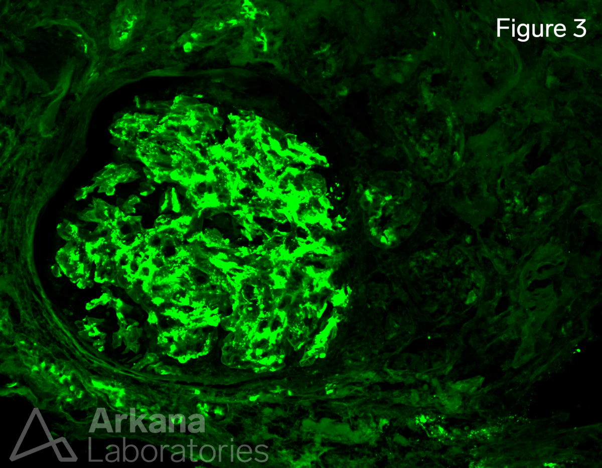 LECT2 amyloidosis