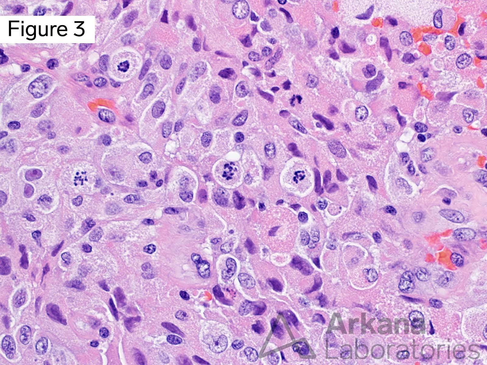 IDH-Wildtype Glioblastoma