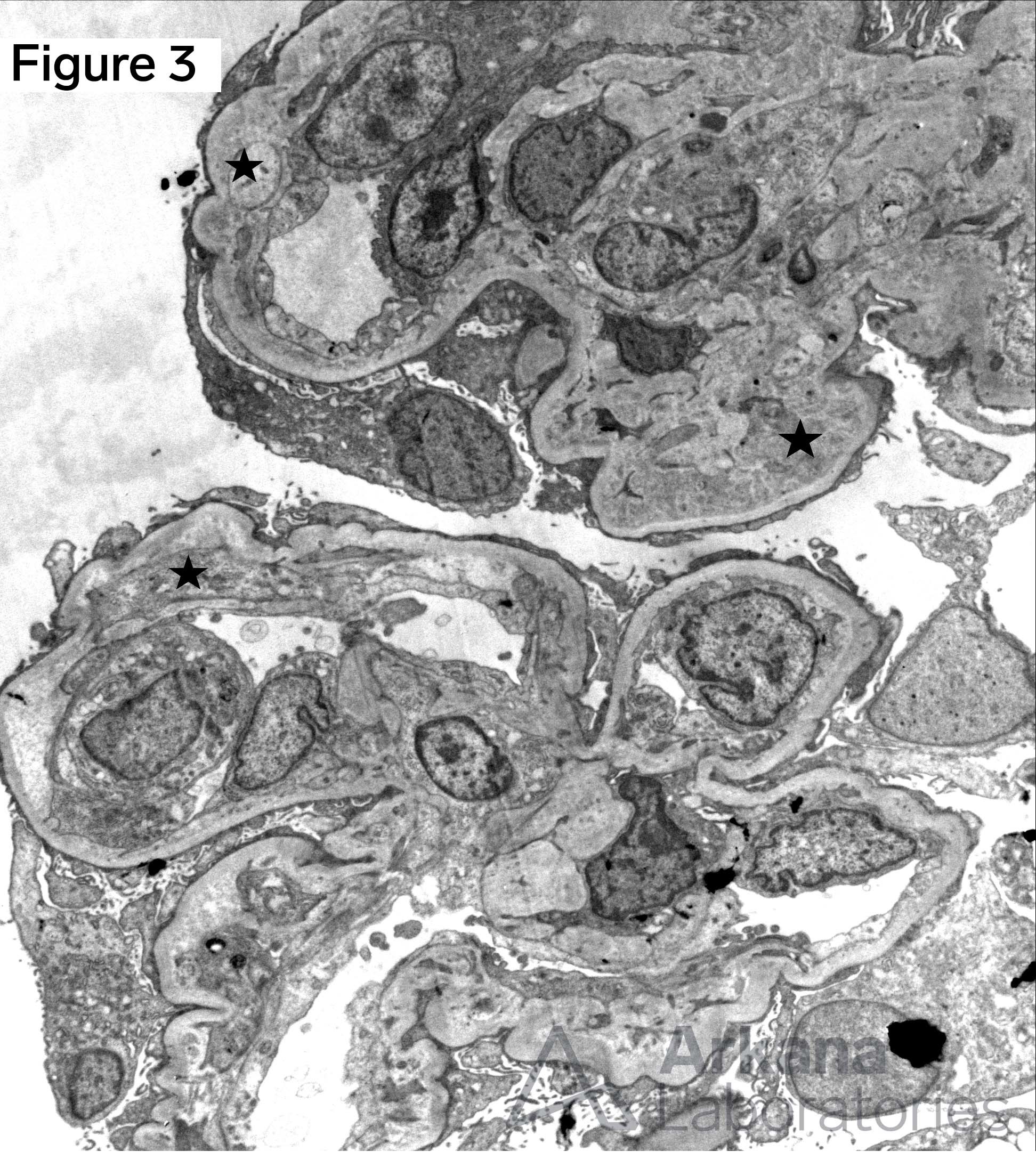 thrombotic microangiopathy