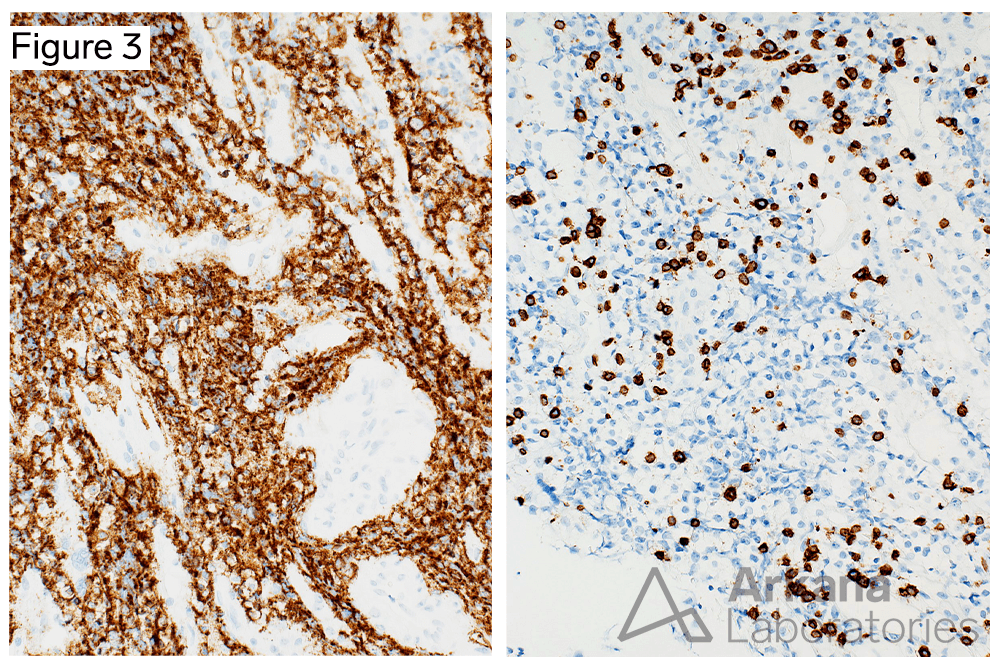 B-cell Lymphoma