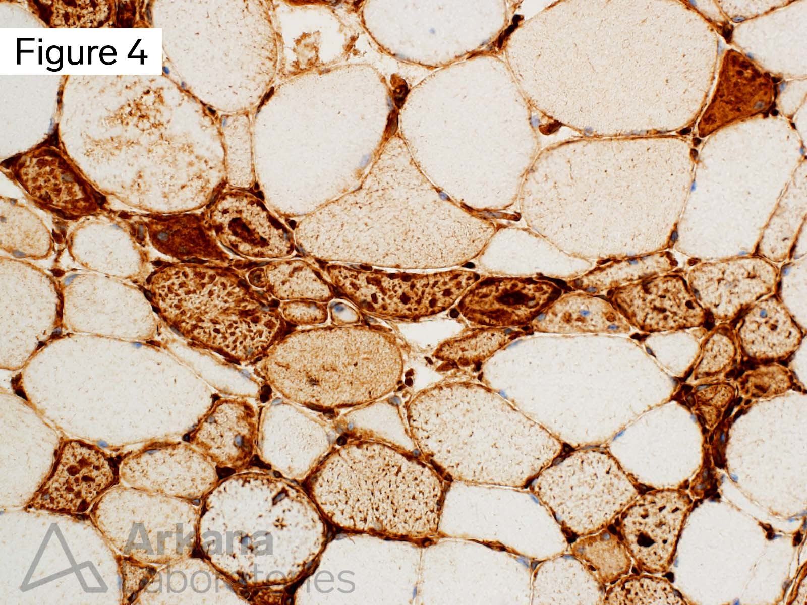 Vacuolar myopathy