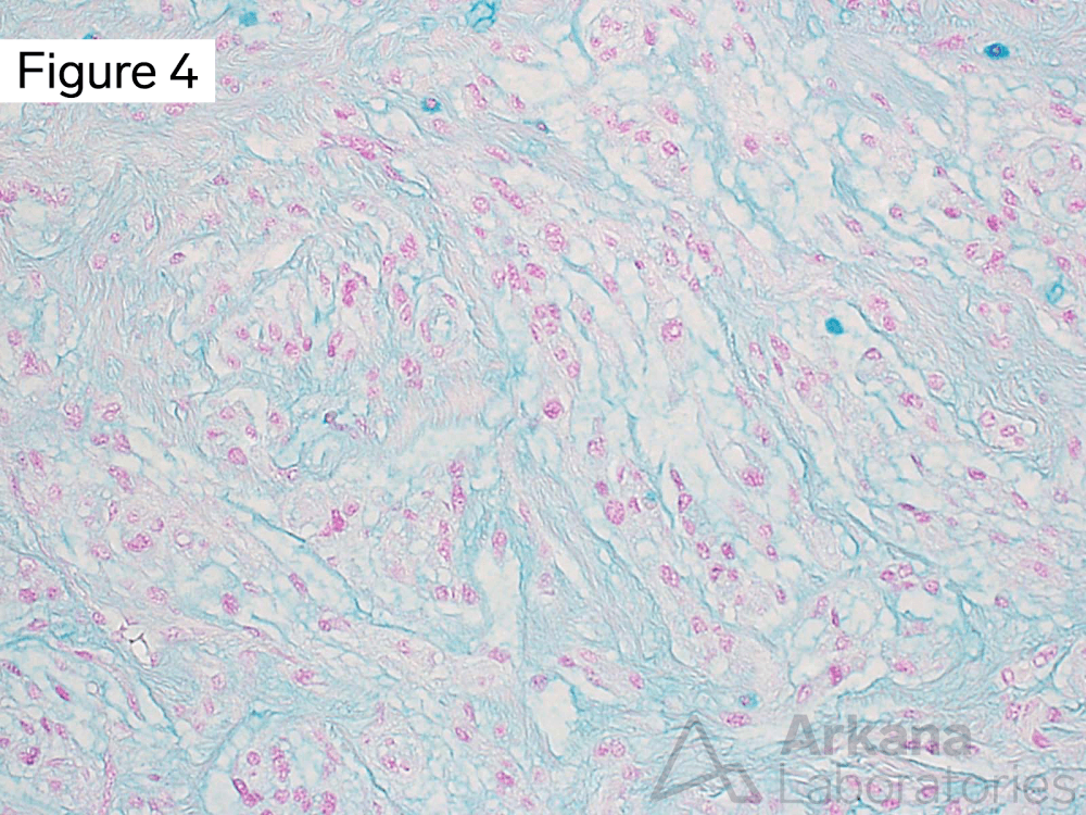 Chordoid meningioma