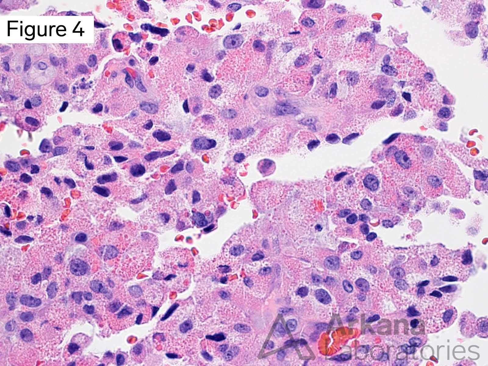 IDH-Wildtype Glioblastoma