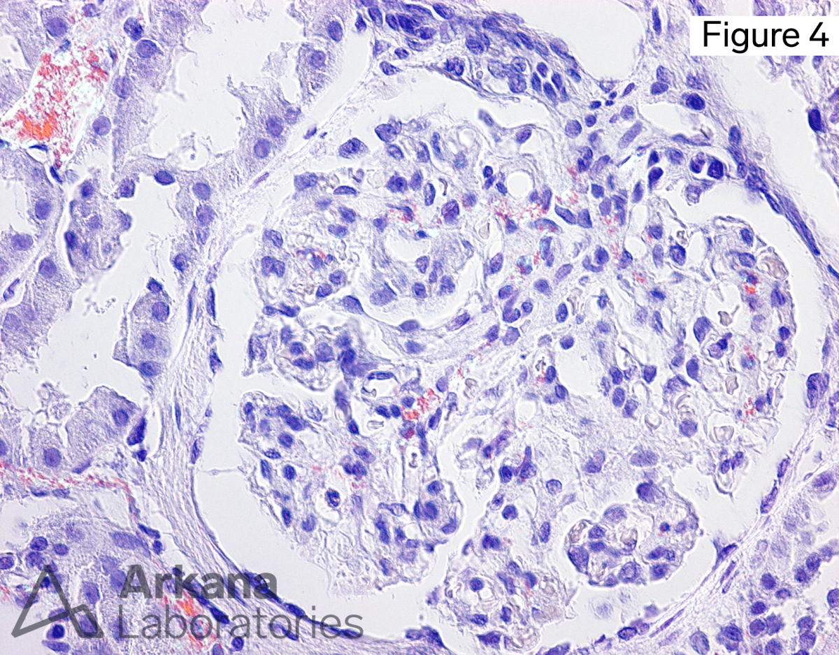 LECT2 amyloidosis